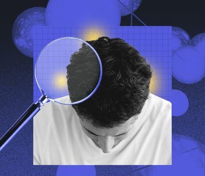 Is It Really Dandruff? The Science Behind Seborrheic Dermatitis