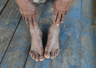 Lilly's Ebglyss Cleared or Nearly Cleared Hand and Foot Eczema in 53% of Patients Versus 27% on Placebo