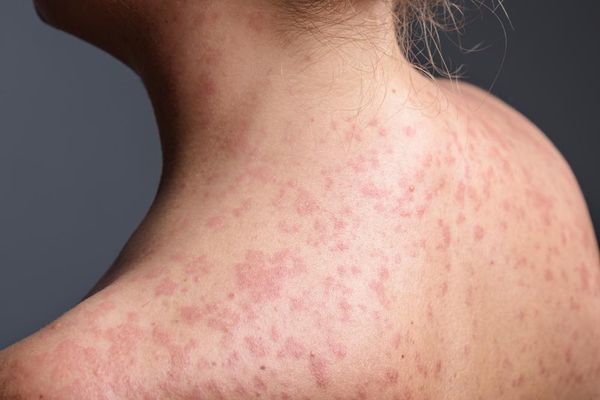 Pennsylvania faces largest measles outbreak in decades as case count rises to 1,000