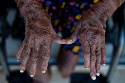 Her Fingers Looked Badly Deformed Until She Made a Fist, and the Clue Pointed Doctors to Lupus