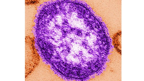 US reports 4,410 measles cases in 2026; Pennsylvania emerges as latest hotspot: CDC report