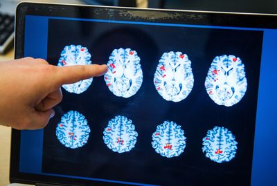 A Rare Brain-Infecting Mold Can Strike Healthy Adults, and Diagnosis Often Requires Brain Tissue Rather Than Spinal Fluid