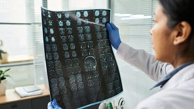 Researchers use ChatGPT-style technology to predict stroke risk from a person’s DNA