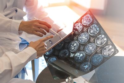 What is multiple sclerosis? The autoimmune disease affecting 3 million people
