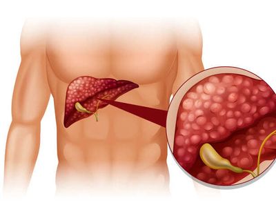 5 Fatty Liver Subtypes Could Change How Doctors Assess Risk