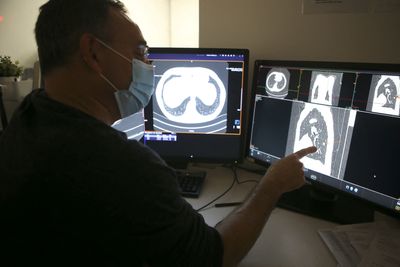 18% of Eligible U.S. Adults Got Lung Cancer Screening in 2022, With Most Unaware the Test Existed