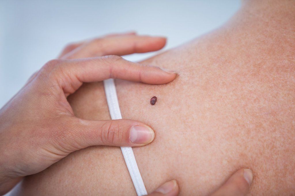 what-is-melanoma-and-what-are-the-early-signs-of-the