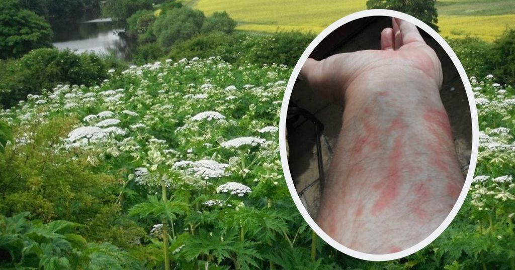The blistercausing giant plant in Wales, the damage…