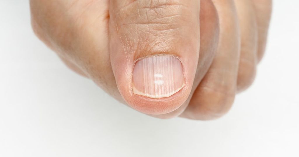 White spots on fingernails why you get them and it's…