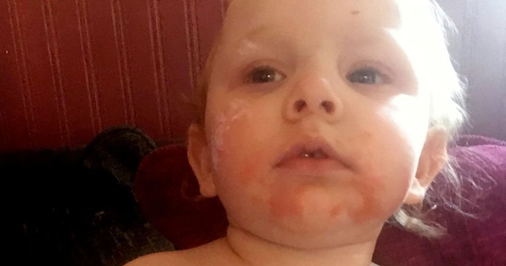 Toddler suffers 'burn-like' rash after spilling…