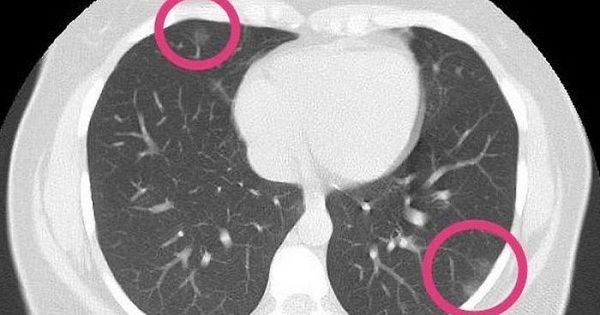 Scan finds coronavirus in lungs of healthy woman, 30, with no symptoms