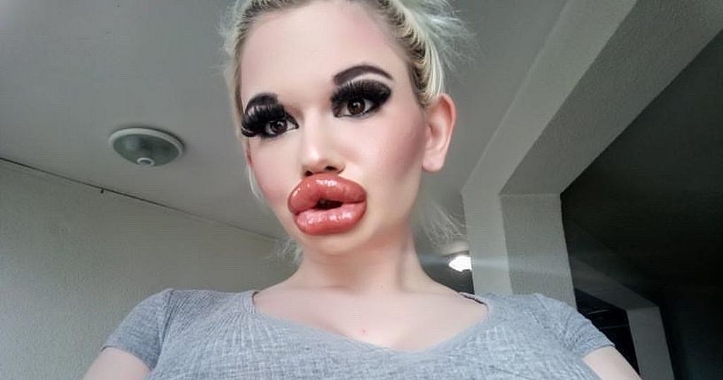 Woman with 'biggest lips in world' shows off huge new…
