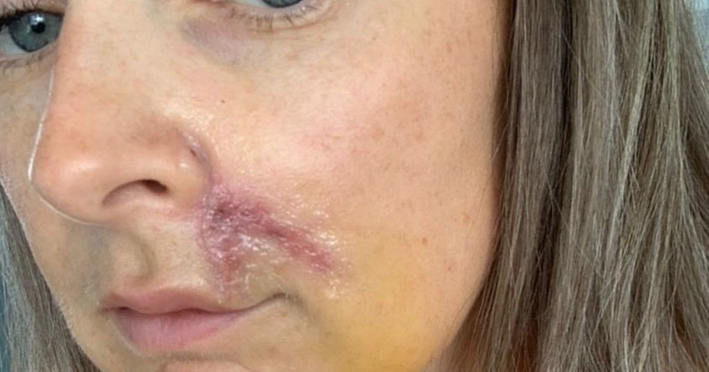 Woman left with wonky mouth after skin tag on neck…